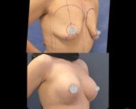 نتائج عملية تجميل الثدي قبل وبعد في Turan Turan Health Group، رفع وتحديد الثدي