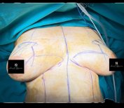 Preoperative stage of mammoplasty at Turan Turan Health Group, breast surgery preparation