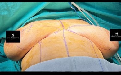 Підготовка до зменшення грудей у Turan Turan Health Group, видно передопераційну розмітку