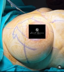 Результат зменшення грудей у Turan Turan Health Group, помітне покращення контуру