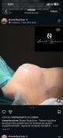 Результат зменшення грудей у Turan Turan Health Group, помітне покращення контуру