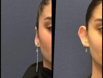 Foto prima e dopo di Ricostruzione dell'orecchio realizzate dal Dott./Dott.ssa 