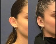 Foto prima e dopo di Ricostruzione dell'orecchio realizzate dal Dott./Dott.ssa 