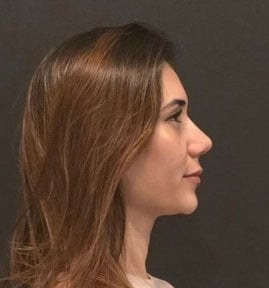 Rhinoplasty result at Turan Turan Health Group, improved nose profile after surgery