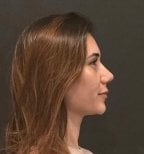 Rhinoplasty result at Turan Turan Health Group, improved nose profile after surgery
