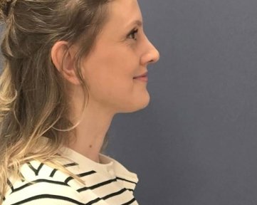 Rhinoplasty result at Turan Turan Health Group, improved nose profile and natural look