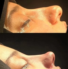 Résultats avant et après rhinoplastie chez Turan Turan Health Group, profil du nez amélioré