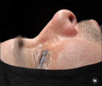 Résultat de rhinoplastie chez Turan Turan Health Group, forme du nez améliorée après chirurgie