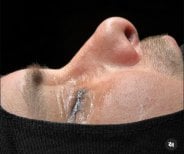 Résultat de rhinoplastie chez Turan Turan Health Group, forme du nez améliorée après chirurgie