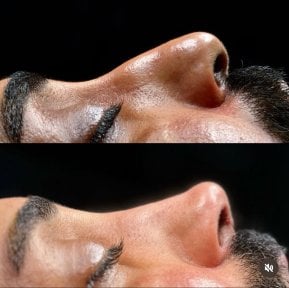 Résultats avant/après rhinoplastie chez Turan Turan Health Group, profil du nez amélioré