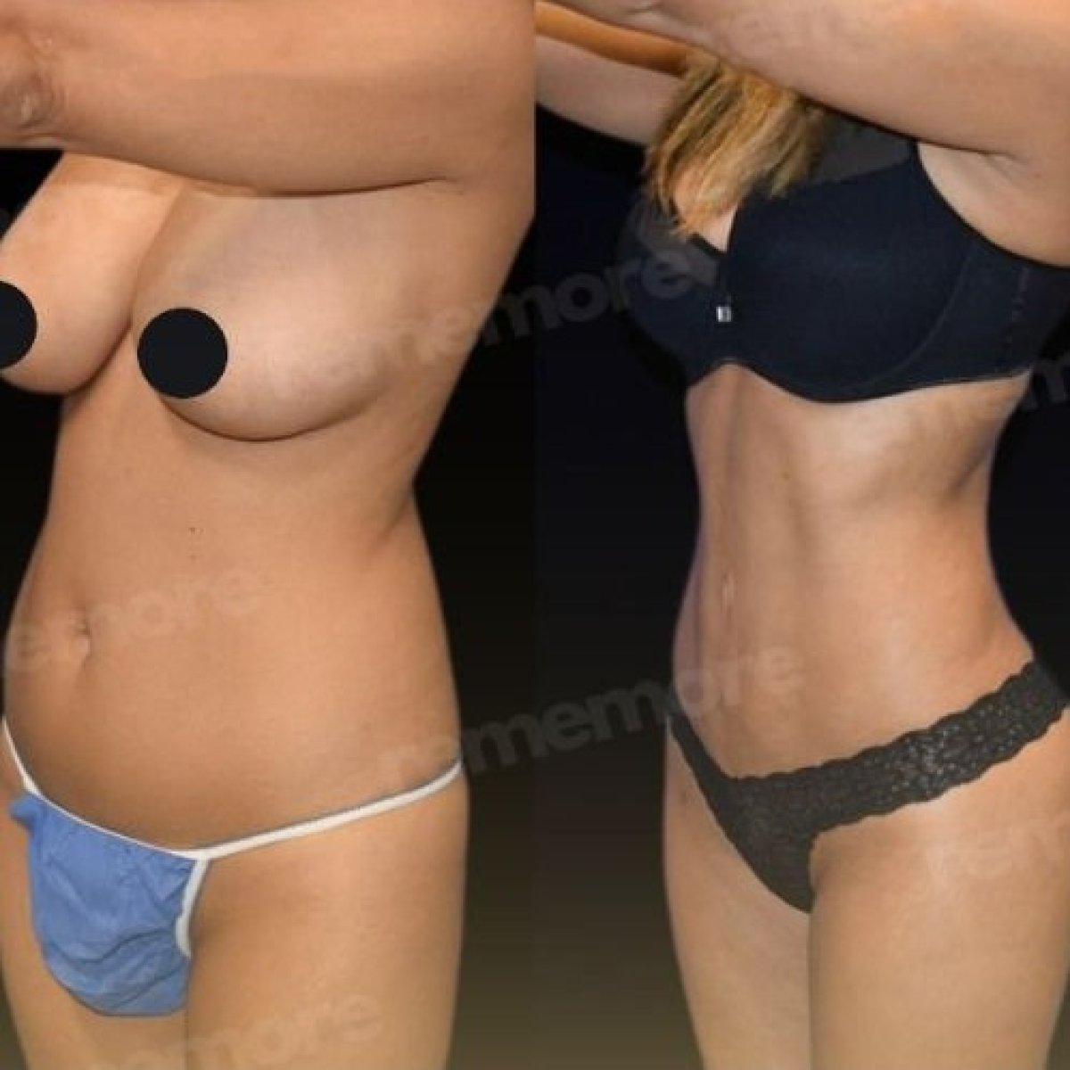 Resultados de lipoescultura 360 antes y después en Memorial Şişli Hospital, mejor contorno corporal