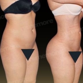 before-after photo 360-liposuction