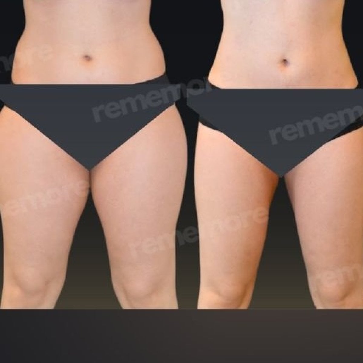 Resultados de liposucción 360 antes y después en Memorial Şişli Hospital, mejora corporal