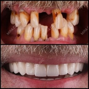 Resultados antes y después de implantes dentales en Mira Clinic, sonrisa restaurada y dientes sanos