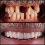 Resultados antes y después de implantes dentales en Mira Clinic, sonrisa restaurada y dientes sanos