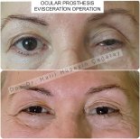Before and after ocular prosthesis evisceration results at DrCagatay Eye Clinic
