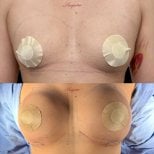 Before and after breast augmentation results at Lucio Santos Plastic Surgery, enhanced volume