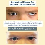 Before and after strabismus surgery results at DrCagatay Eye Clinic for exotropia correction
