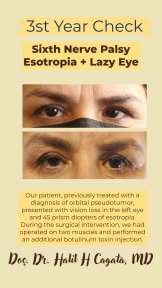 Before and after strabismus surgery for sixth nerve palsy at DrCagatay Eye Clinic, eye alignment result