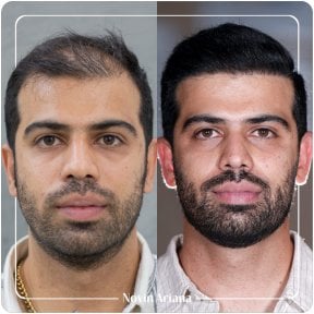 Before and after hair transplant result at Novin Ariana Clinic – restored hairline in male patient