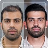 Before and after hair transplant result at Novin Ariana Clinic – restored hairline in male patient