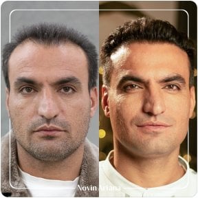 نتيجة زراعة الشعر قبل وبعد في عيادة Novin Ariana – استعادة خط الشعر الممتلئ