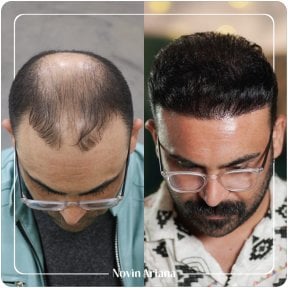 Before and after hair transplant result at Novin Ariana clinic – restored hairline and density