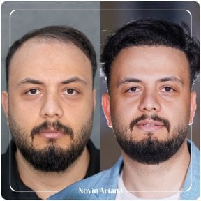 Resultado de trasplante capilar antes y después en Novin Ariana – línea capilar restaurada