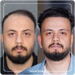 Resultado de trasplante capilar antes y después en Novin Ariana – línea capilar restaurada