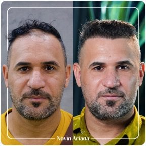 Resultado de trasplante capilar antes y después en Novin Ariana Clinic, línea y densidad mejoradas