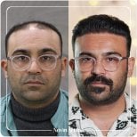 Before and after hair transplant results at Novin Ariana Clinic – restored hairline in male patient