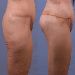 before-after photo brazilian-butt-lift