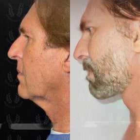 before-after photo endoscopic-facelift