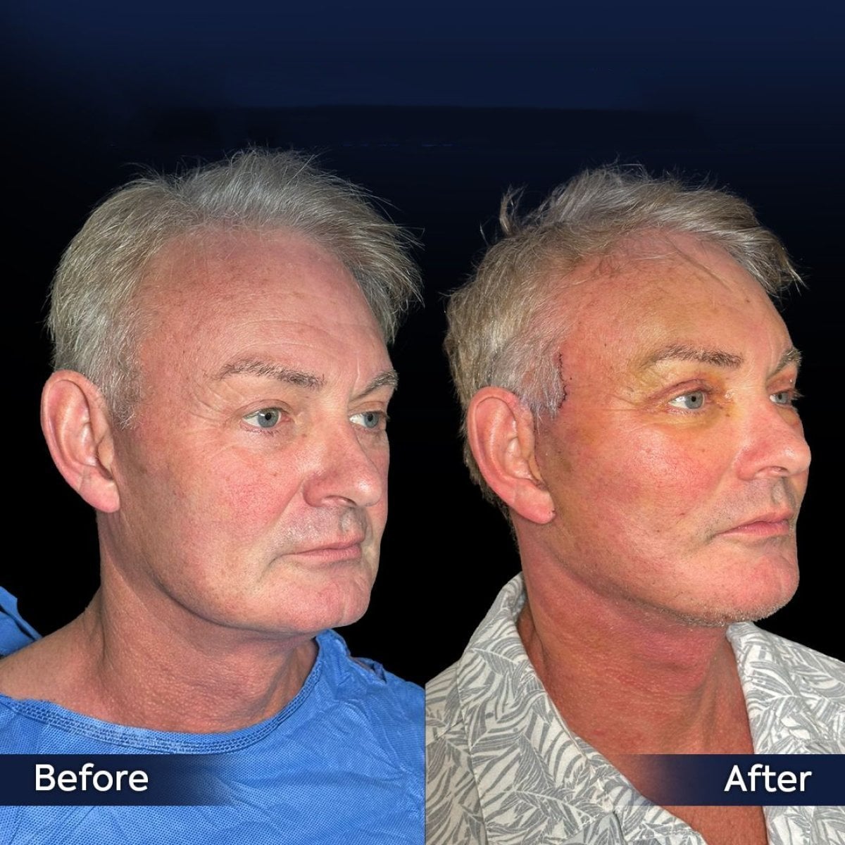 Resultados antes y después de lifting endoscópico facial en Dr. Safa Manav Clinic