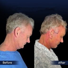 before-after photo endoscopic-facelift