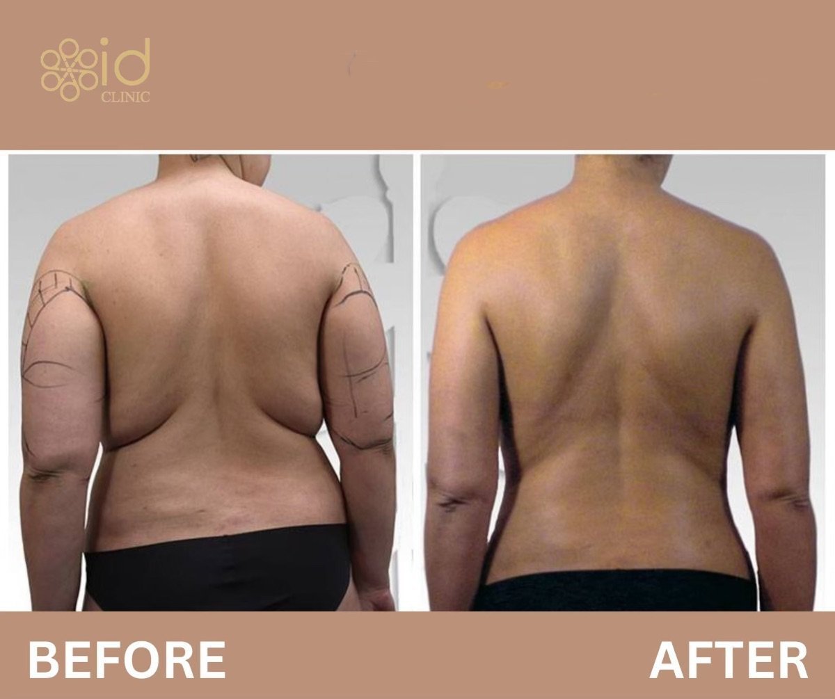 Resultados de liposucción de brazos antes y después en ID Clinic Bangkok, brazos más delgados