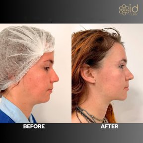 before-after photo liposakcia-vtorogo-podborodka