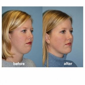 before-after photo liposakcia-vtorogo-podborodka