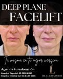 Before and after deep plane facelift results at Lucio Santos Plastic Surgery, facial rejuvenation