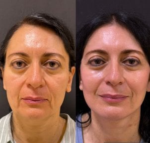 Before and after blepharoplasty results at Lucio Santos Plastic Surgery, eyelid correction