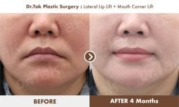 نتائج رفع الشفة الجانبي ورفع زوايا الفم في عيادة Dr. Tak Plastic Surgery