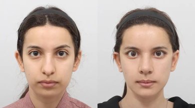 نتائج قبل وبعد Fox Eye Lift في AB Plastic Surgery، تحسين مظهر محيط العين