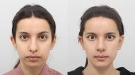 نتائج قبل وبعد Fox Eye Lift في AB Plastic Surgery، تحسين مظهر محيط العين