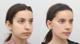 نتائج قبل وبعد Fox Eye Lift في AB Plastic Surgery – تحسين واضح في محيط العين