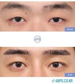 نتائج رأب الجفن قبل وبعد في AB Plastic Surgery، تصحيح الجفون