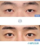 نتائج رأب الجفن قبل وبعد في AB Plastic Surgery، تصحيح الجفون