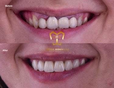 Before and after veneers result at Dentaland Premium Luxury Clinic & Academy, smile makeover