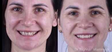 Before and after veneers result at Dentaland Premium Luxury Clinic & Academy, smile makeover
