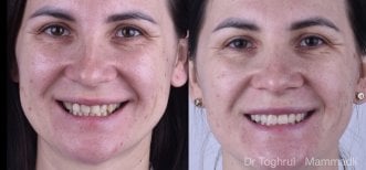 Before and after veneers result at Dentaland Premium Luxury Clinic & Academy, smile makeover