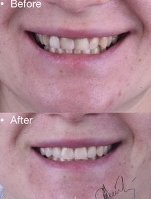 Before and after veneers result at Dentaland Premium Luxury Clinic & Academy, smile makeover